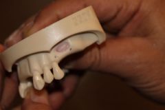 Maxillary Sinus Grafting_6