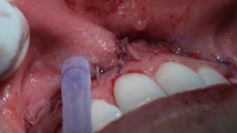 جراحی افزایش طول و طراحی لبخند - اردیبهشت ۹۷