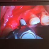 Immediate implementation and immediate loading_16