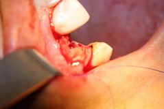 18 th International congress of Iranian association of oral and maxillofacial surgeons_28