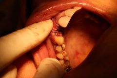 18 th International congress of Iranian association of oral and maxillofacial surgeons_29