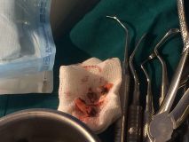 Sinus graft course with live surgey