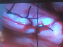 دوره آموزشي سينوس ليفت همراه با جراحي زنده