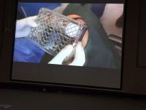 Implant and GBR course in Hamedan_12