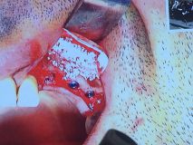 Implant and GBR course in Hamedan_4