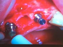 کلاس آموزشی دو روزه  Advanced GBR - مردادماه ۹۵