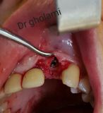 SPI system presentation with live surgery_14