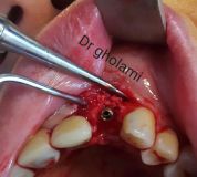 SPI system presentation with live surgery_19