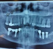 SPI system presentation with live surgery_2