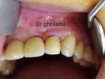 SPI system presentation with live surgery_3