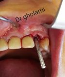 SPI system presentation with live surgery_7